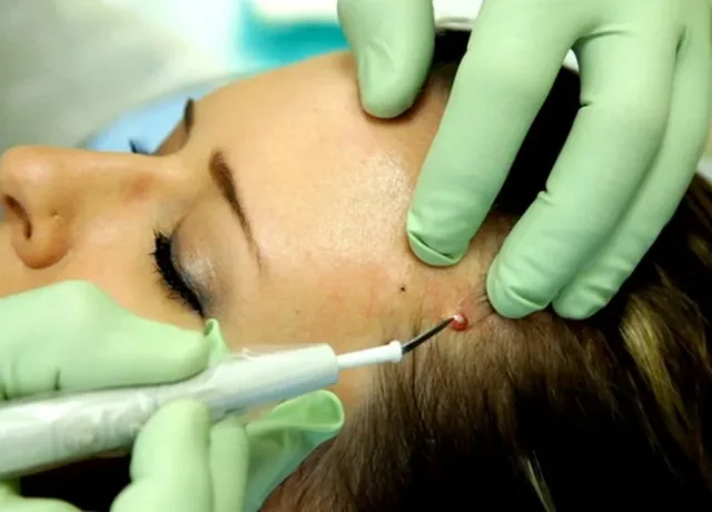 RF Cautery